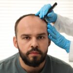 How to Choose the Best Hair Transplant Clinics & Surgeons in Turkey