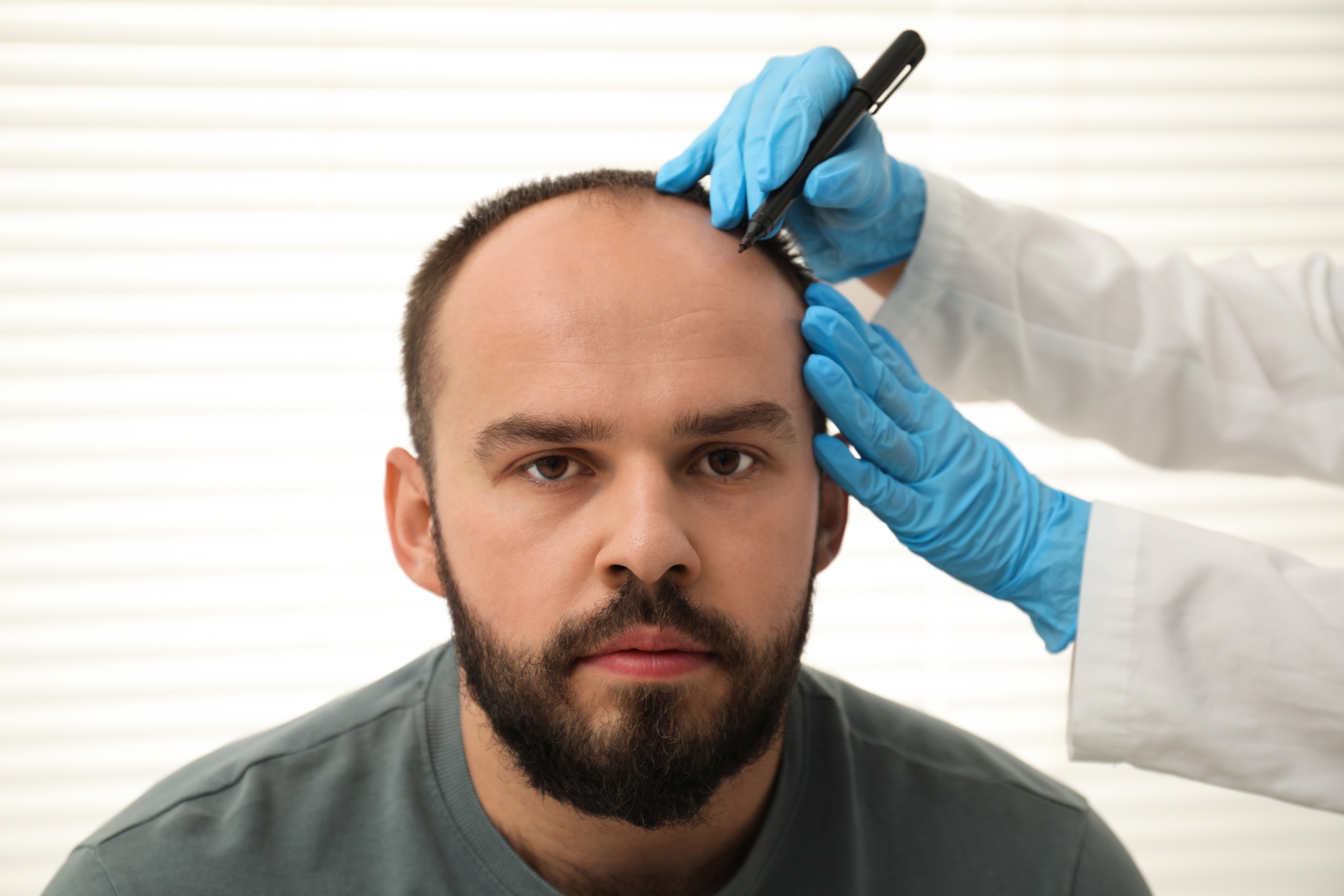 How To Choose The Best Hair Transplant Clinics & Surgeons In Turkey