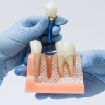 Dental Implants – Why would you Go Abroad Intended for Dental Implants?