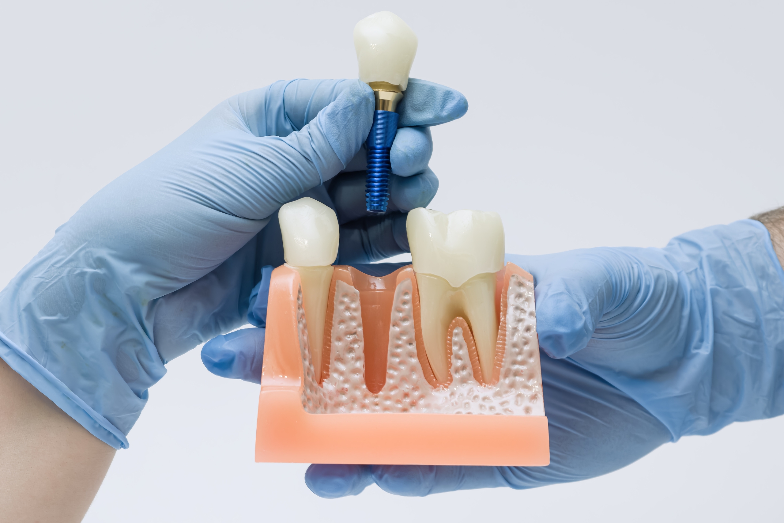 Dental Implants – Why would You Go Abroad Intended For Dental Implants?