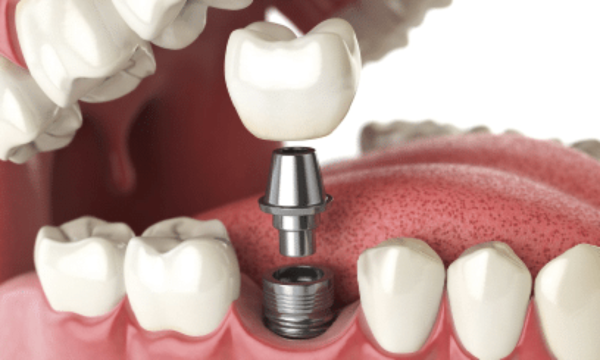Dental care Implants – The Best Countries to Find Dental Implants
